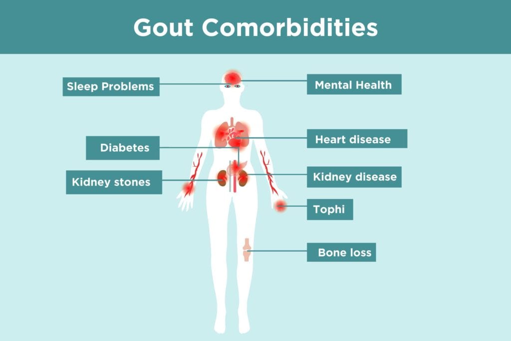 0619 Gout Comorbidities 1024x683 1 